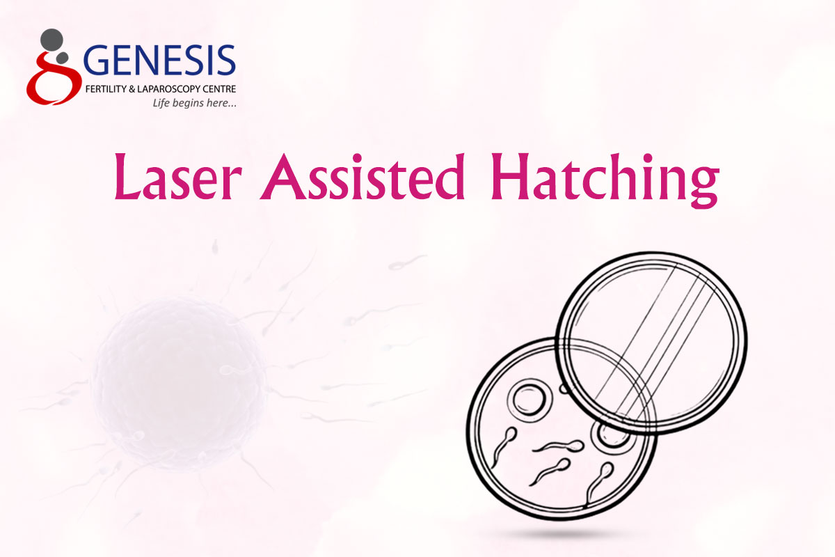 Laser Assisted Hatching